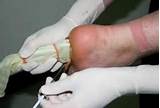 Doctor To See For Plantar Fasciitis