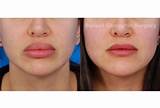 Lip Reduction Surgery Recovery Time