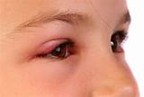 Pictures of Severe Eye Allergy Treatment