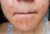 Allergic Reaction Acne Treatment Images