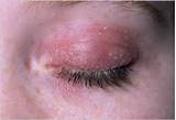 Photos of Inflamed Eyelid Home Remedies