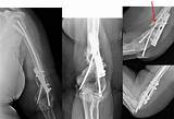 Images of Broken Humerus Bone Recovery Time