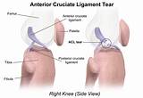 Pictures of Posterior Cruciate Ligament Tear Treatment
