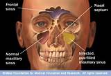 Medication For Swollen Nasal Passages Photos