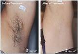 Images of Laser Hair Removal First Treatment Results