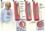 Angioplasty Recovery Time Photos