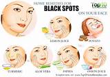 Images of Black Spot On Face Removal Home Remedy