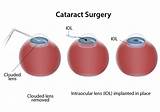 Cataract Surgery Recovery What To Expect Pictures