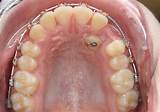 Images of Impacted Tooth Treatment