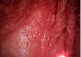 Images of Genital Warts Inside Anus Treatment