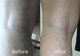 Spider Vein Treatment Before And After Photos