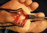 Pictures of Treatment For Plantar Fascial Fibromatosis