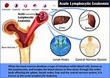 Images of Acute Lymphoblastic Leukemia Treatment Cost