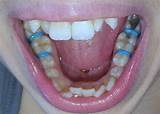 Photos of Orthodontic Separators