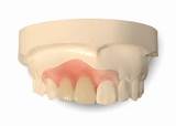 Flipper Denture Repair Pictures