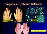 Images of Scleroderma Mayo Clinic