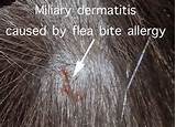 Miliary Dermatitis Home Remedies Pictures