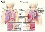 Breathing Exercises During Pneumonia Pictures