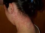 Photos of Scabies Doctor