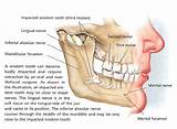 Images of Wisdom Teeth No Dental Insurance