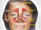 Images of Home Remedies For Swollen Nasal Turbinates
