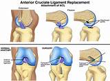 Images of Acl Hamstring Graft Recovery