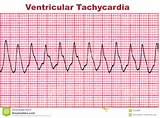 Heart Arrhythmia Monitor Images