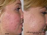 List Of Acne Treatments Pictures