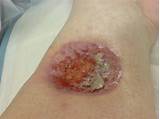 Silver Nitrate In Wound Care Images
