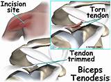 Bicep Tendon Surgery Recovery Photos