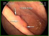 Pictures of Cancerous Polyps In Colon Treatment