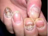 Bad Fingernails Treatment