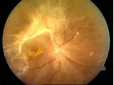 Retinal Detachment Surgery Gas Bubble Photos
