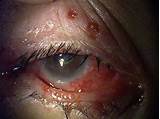 Herpes Around The Eye Treatment Pictures