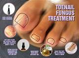 Images of Severe Foot Fungus Treatment