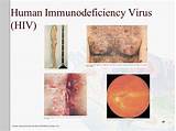 Human Immunodeficiency Virus Treatment Images
