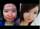 Images of How To Cover Cystic Acne With Makeup