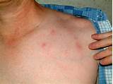 Hay Mite Bites Treatment Pictures