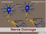 Nerve Repair Surgery Recovery
