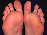 Medication For Blisters On Feet Images