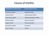 Angular Cheilitis Medication