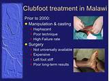 Clubfoot Treatment Cost Pictures