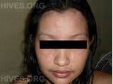 Medication For Hives On Face Pictures