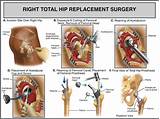 Hip Bone Surgery Recovery Time Images