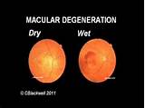 Photos of Vitamin Therapy For Macular Degeneration