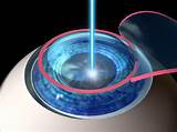 Pictures of Does Lasik Eye Surgery Work For Astigmatism