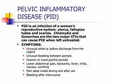 Images of Pelvic Inflammatory Disease Treatment Antibiotics