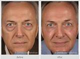 Side Effects Of Dermal Fillers Under Eyes