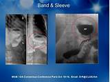 Esophageal Varices Banding Recovery Pictures