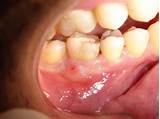 Pictures of Oral Fistula Treatment